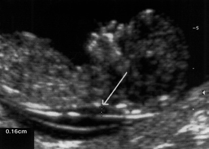 Ultrasound image demonstrating nuchal translucency measurement at 13 weeks gestation