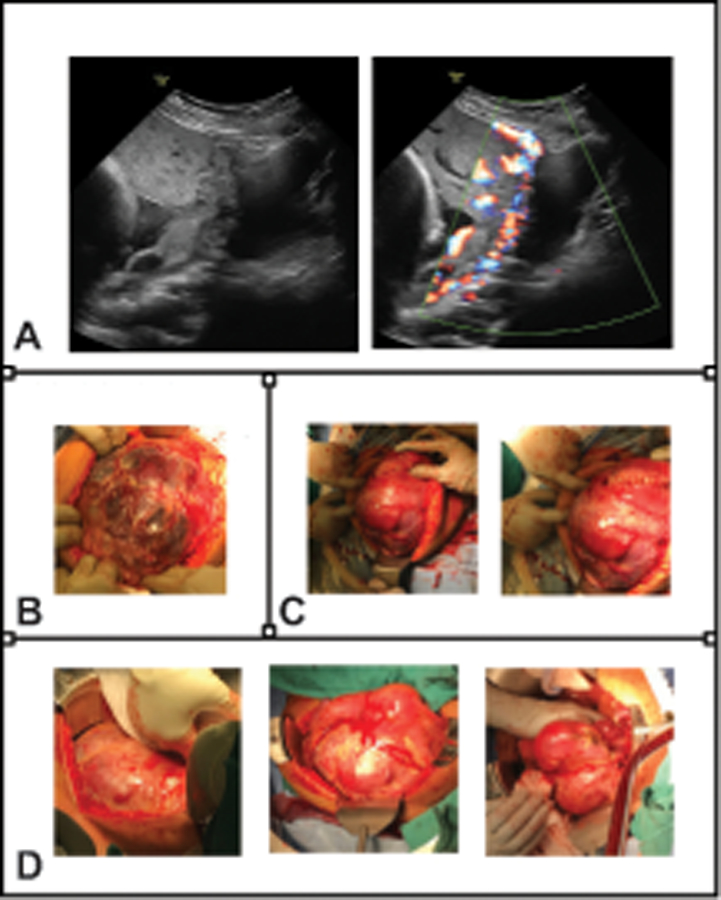 Ultrasound and surgical images showing severe placenta accreta spectrum with placental lacunae and hypervascularity