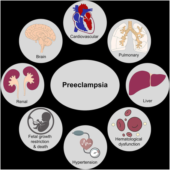 Diagram showing multiple organ systems affected by preeclampsia including brain, liver, kidneys, and placenta