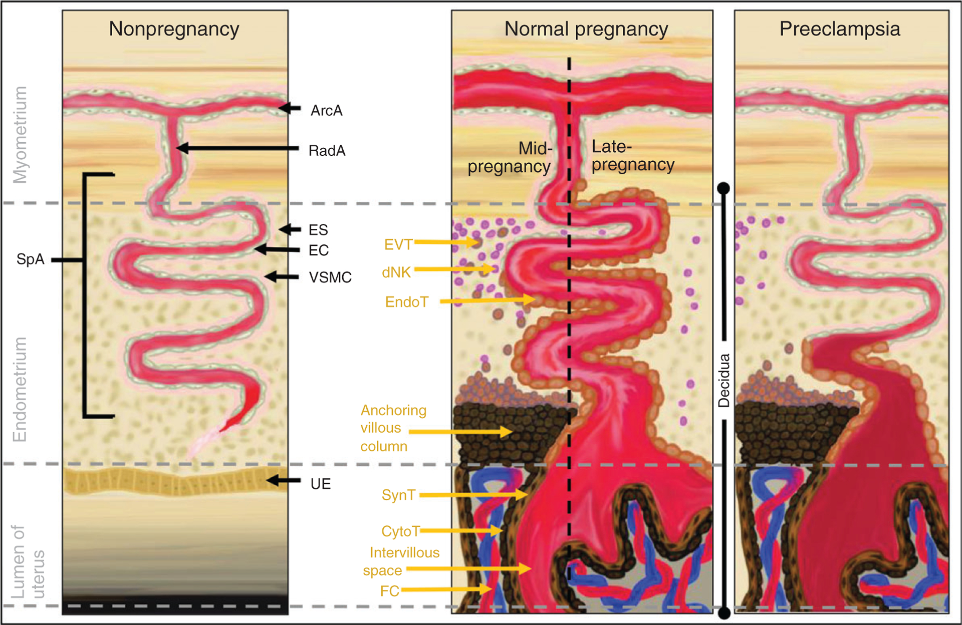 Diagram comparing normal versus preeclamptic spiral artery remodeling showing failed trophoblast invasion