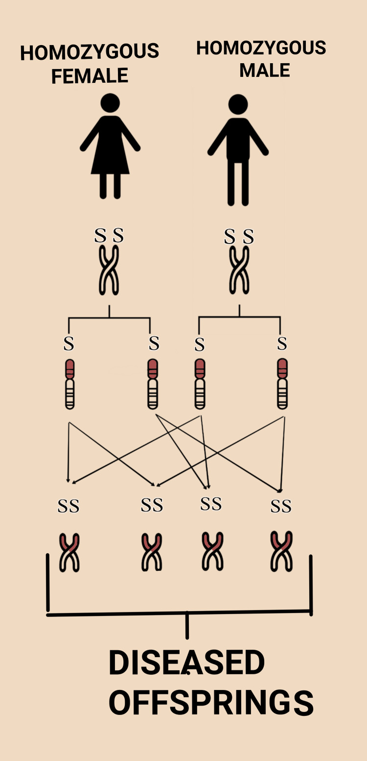 Inheritance pattern diagram showing autosomal recessive transmission of sickle cell disease from carrier parents