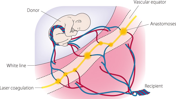 Diagram illustrating the Solomon technique for fetoscopic laser coagulation showing continuous line along vascular equator