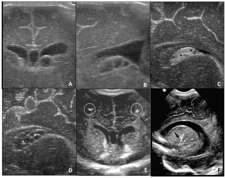 Prenatal ultrasound showing features of congenital CMV infection including periventricular calcifications and ventriculomegaly