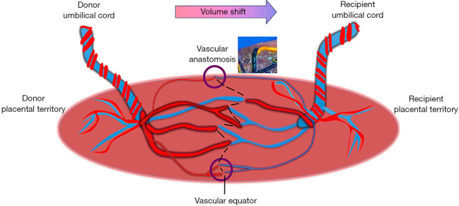Diagram of monochorionic placenta showing arteriovenous anastomoses between twin circulations