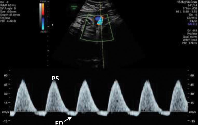 Abnormal umbilical artery Doppler waveform showing absent end-diastolic flow