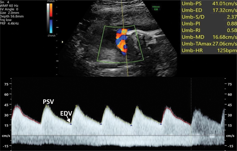 Normal umbilical artery Doppler waveform showing continuous forward flow in diastole