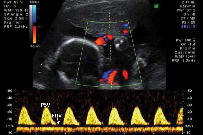 Abnormal umbilical artery Doppler waveform showing reversed end-diastolic flow