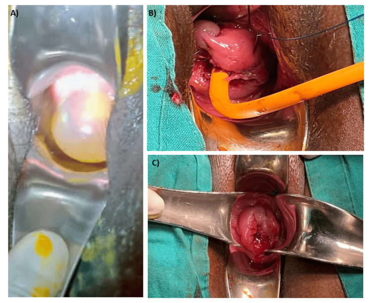 McDonald cervical cerclage technique showing preoperative, intraoperative, and postoperative views