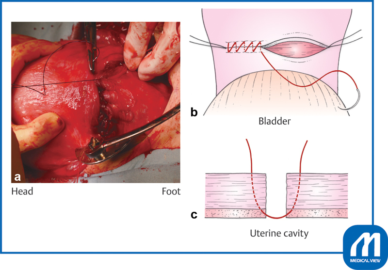 Surgical illustration of uterine closure technique during cesarean section showing running suture
