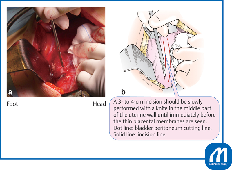 Surgical illustration of low transverse uterine incision during cesarean section