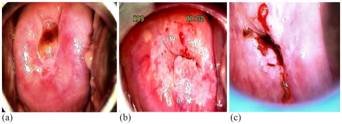 Colposcopy images showing different transformation zone types with acetowhite lesions