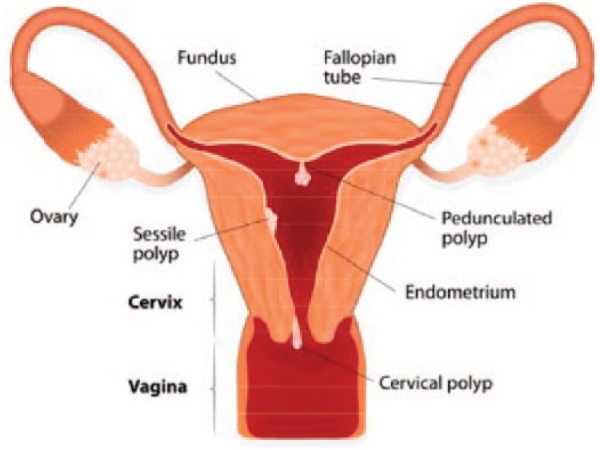 Illustration of sessile and pedunculated endometrial polyps as seen during hysteroscopy