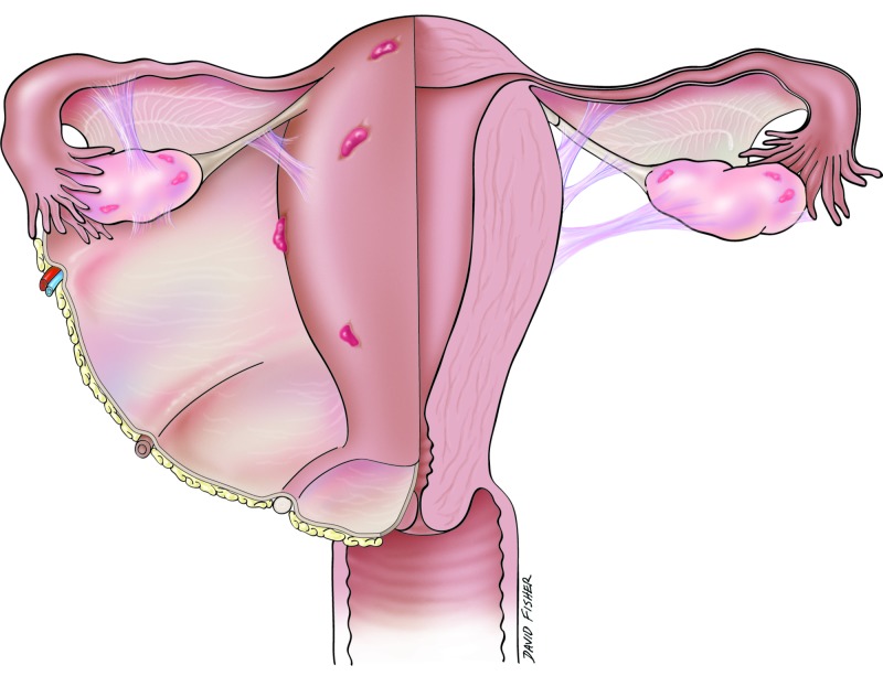 Schematic diagram showing anatomical areas commonly involved in endometriosis including ovaries, uterosacral ligaments, and peritoneal surfaces