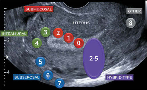 FIGO classification of uterine fibroids showing types 0-8 with submucosal, intramural, and subserosal locations