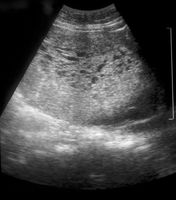 Transvaginal ultrasonogram of a complete hydatidiform mole showing snowstorm pattern with multiple cystic spaces
