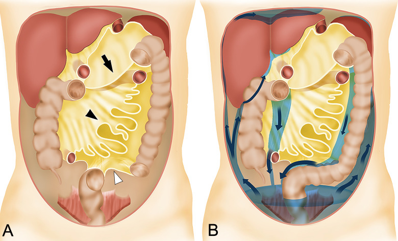 Pattern of intraperitoneal spread of ovarian cancer showing preferential flow of peritoneal fluid