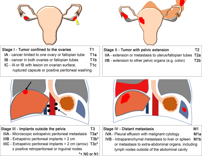 FIGO and TNM staging system for ovarian cancer with anatomical diagrams