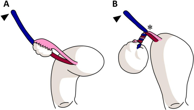 Anatomical diagram illustrating ovarian torsion with twisted vascular pedicle and whirlpool sign