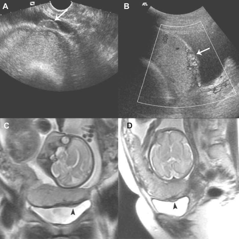 Color Doppler ultrasound and MRI showing placenta accreta with bladder involvement