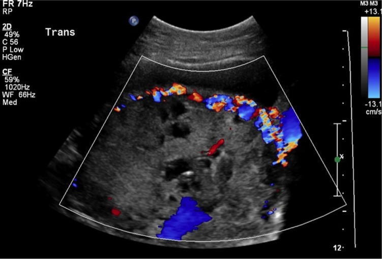 Ultrasound demonstrating vascular lacunae within placental tissue in placenta accreta