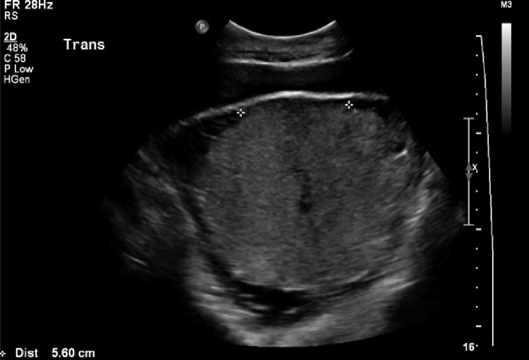 Ultrasound showing loss of the normal retroplacental sonolucent zone in placenta accreta