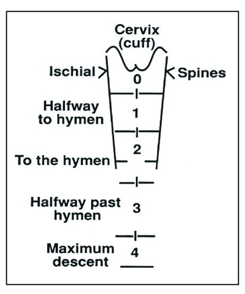 Pelvic organ prolapse grading system showing progressive degrees of descent from normal to complete eversion
