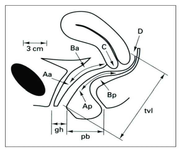 POP-Q measurement points diagram showing anatomical reference landmarks Aa, Ba, C, D, Ap, Bp relative to the hymen