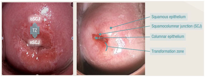 Cervical transformation zone types illustrated with squamocolumnar junction anatomy