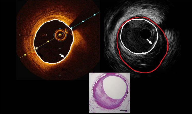 OCT imaging of coronary stent showing stent strut apposition, tissue coverage, and lumen assessment