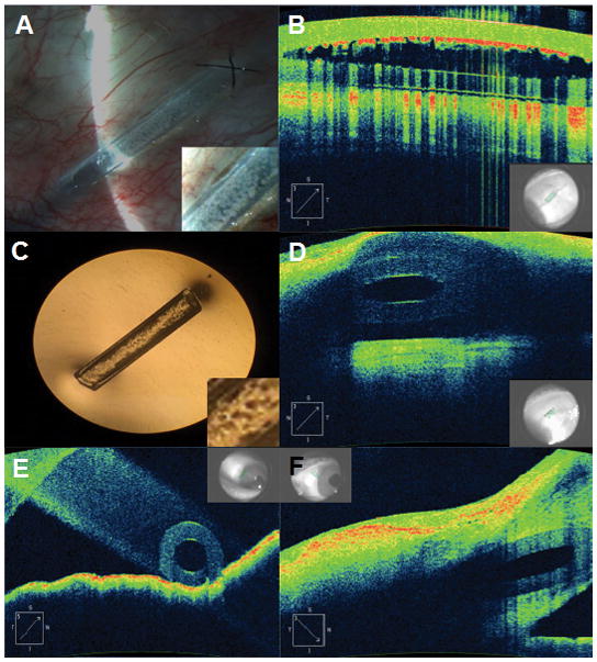 Anterior segment OCT showing a patent Ahmed glaucoma valve tube in the anterior chamber