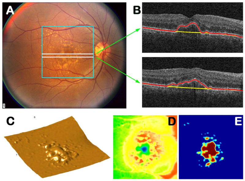 OCT and fundus imaging showing large drusen deposits beneath the RPE in age-related macular degeneration
