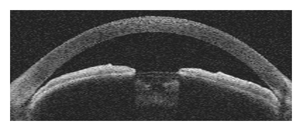 Anterior segment OCT showing a narrow angle with iris-corneal apposition characteristic of angle closure