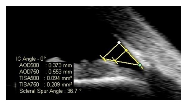 Anterior segment OCT showing quantitative angle measurements including trabecular-iris angle and angle opening distance