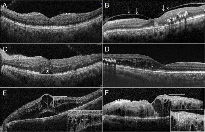 OCT cross-sections showing diabetic macular edema with intraretinal cysts and subretinal fluid