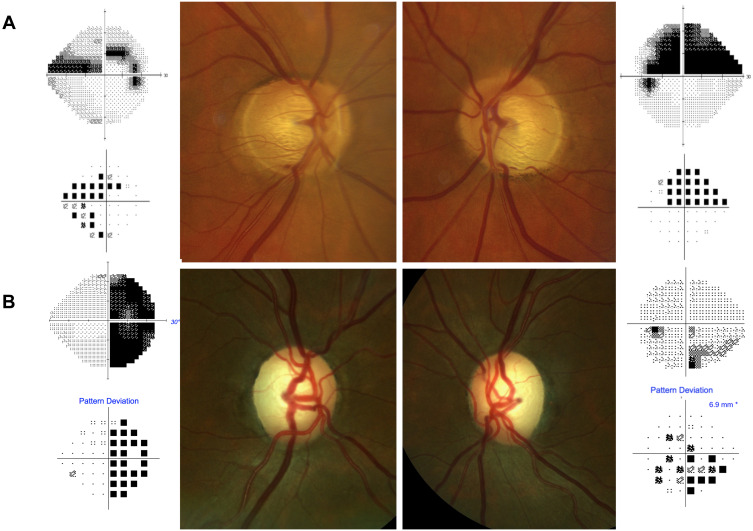 Comparison of glaucomatous versus non-glaucomatous optic disc cupping showing differences in neuroretinal rim and cup morphology
