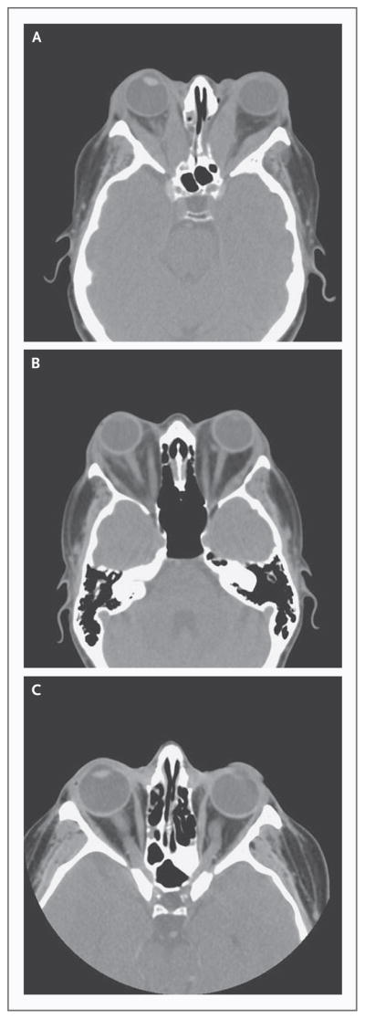 CT scan of the orbits showing enlarged extraocular muscles and bilateral proptosis in Graves ophthalmopathy