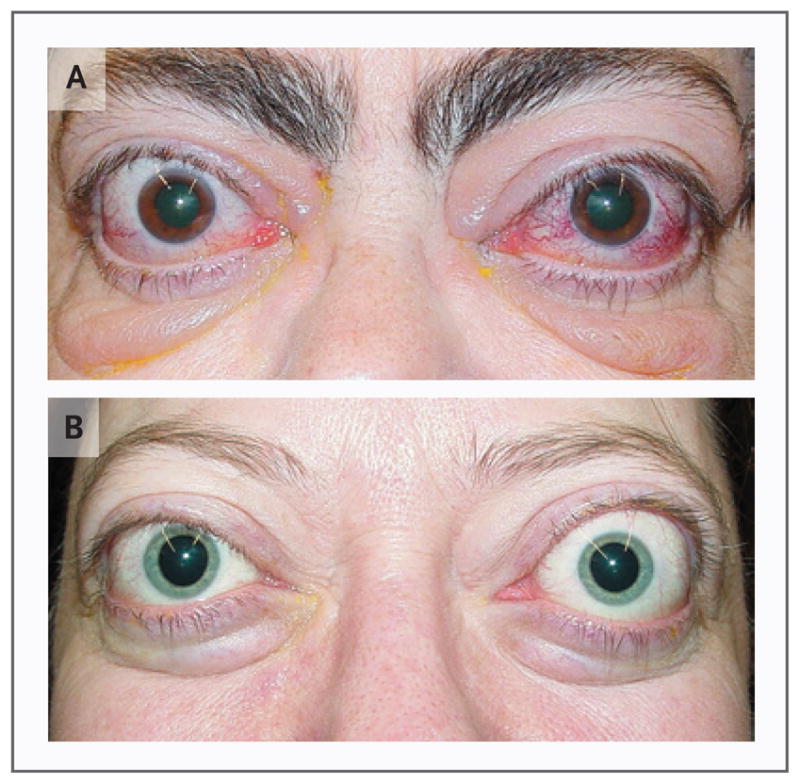 Clinical photographs of patients with Graves ophthalmopathy showing proptosis, lid retraction, and periorbital edema