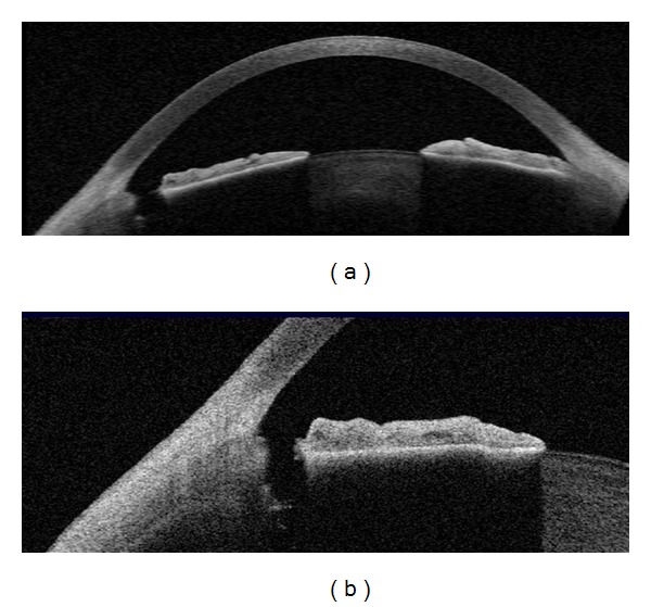 Anterior segment OCT showing a patent laser peripheral iridotomy with widened angle