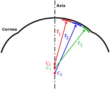 Sagittal curvature map reconstruction showing keratoconic corneal cone on topography