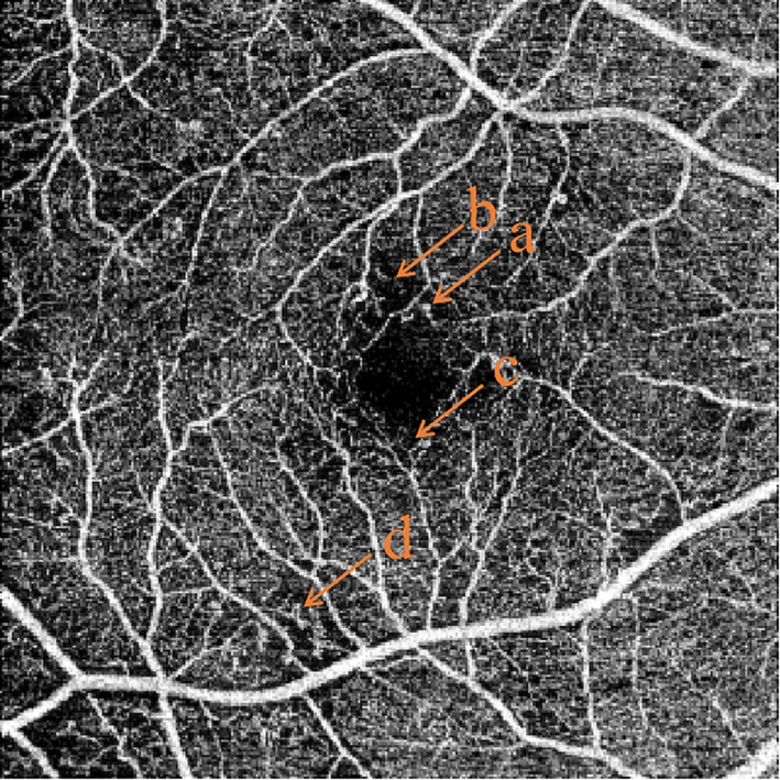 OCT angiography images showing capillary non-perfusion and microaneurysms in non-proliferative diabetic retinopathy
