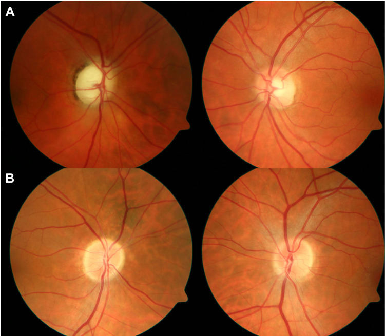 Fundus photographs comparing arteritic anterior ischemic optic neuropathy (AAION) and non-arteritic AION disc appearance