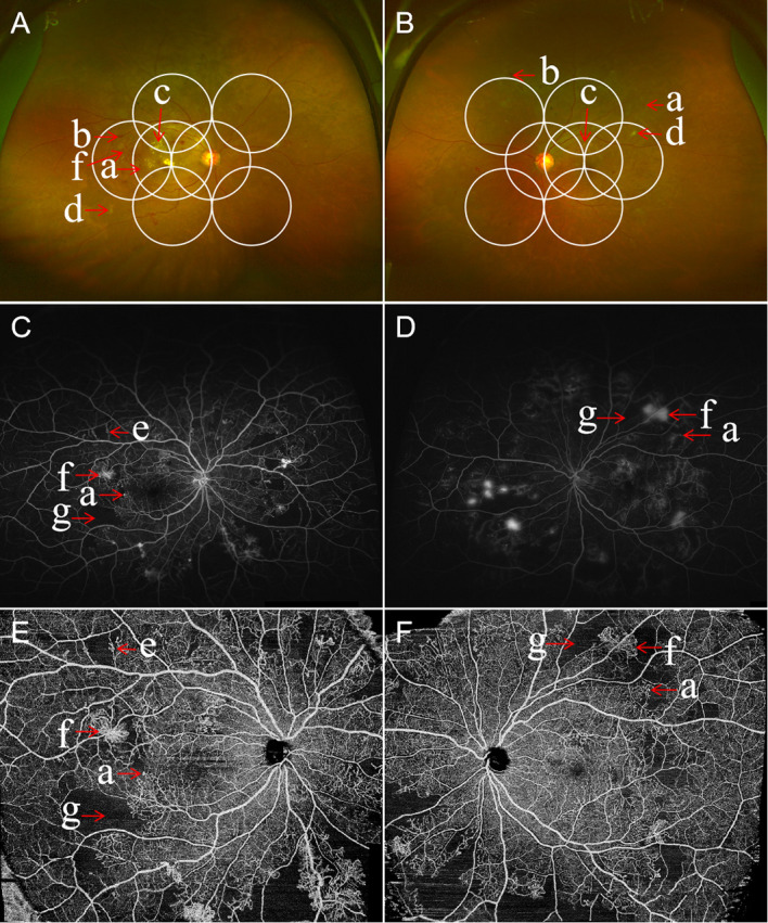 Multimodal imaging of proliferative diabetic retinopathy showing neovascularization on fundus photography and fluorescein angiography