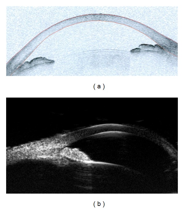 Anterior segment OCT comparison showing plateau iris configuration with anteriorly positioned ciliary body