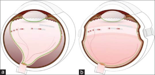 Fundus photograph showing retinal detachment with lattice degeneration in a clinical case