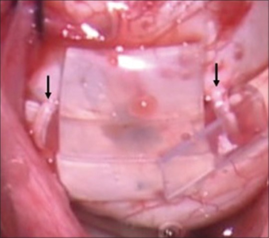 Intraoperative photograph demonstrating sutureless scleral buckling technique for retinal detachment repair