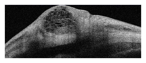 Anterior segment OCT showing a functioning filtering bleb after trabeculectomy with fluid-filled space