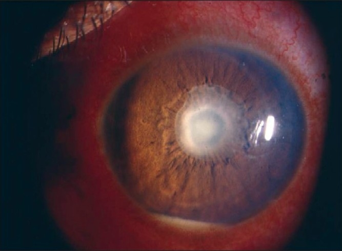 Slit lamp photograph showing hypopyon with pupillary membrane in severe anterior uveitis
