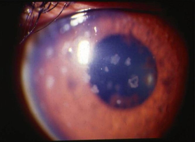 Slit lamp photograph showing keratic precipitates on the corneal endothelium in anterior uveitis