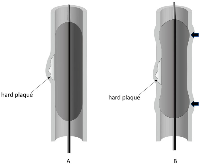 Endovascular stent types for peripheral arterial disease including self-expanding nitinol and balloon-expandable designs