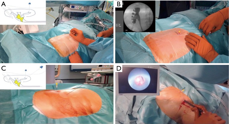 Percutaneous nephrolithotomy needle puncture technique under fluoroscopic guidance